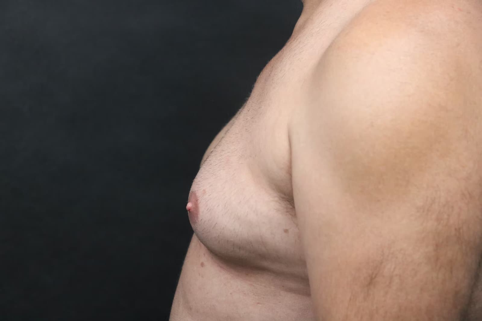 Hi Def gynecomastia surgery in Hyderabad